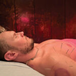 acupuncture